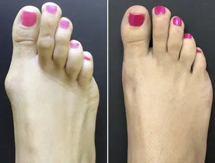 The Original Bunion Corrector Socks. 9 gempages 519647500169118897 1d50c5a6 938f 4f77 a6c4 4e7ffc31cc2b